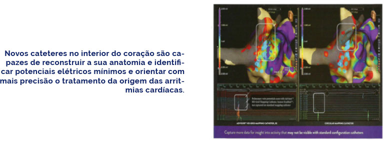 Novos cateteres no interior do coração são capazes de reconstruir a sua anatomia e identificar potenciais elétricos mínimos e orientar com mais precisão o tratamento da origem das arritmias cardíacas.