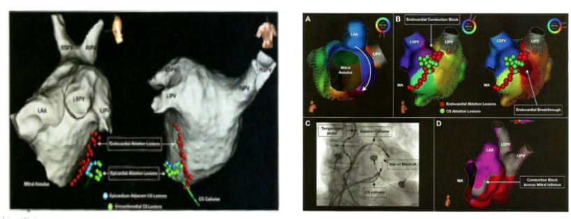 Reconstrução da anatomia do átrio esquerdo do coração em três dimensões , para orientar a o isolamento das veias pulmonares, focos da maioria das fibrilações atriais e de estruturas adjacentes ás veias pulmonares.