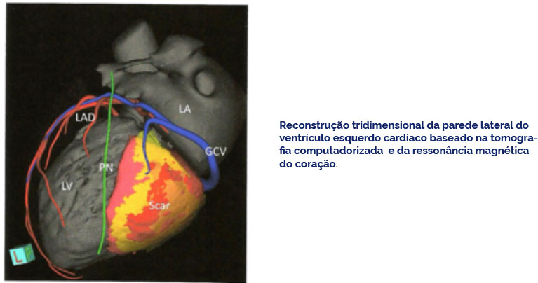 Reconstrução tridimensional da parede lateral do ventrículo esquerdo cardíaco baseado na tomografia computadorizada e da ressonância magnética do coração.