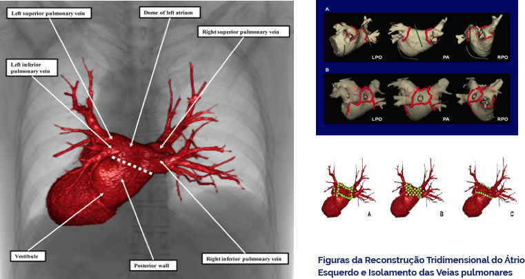 Figuras da Reconstrução Tridimensional do Átrio Esquerdo e Isolamento das Veias pulmonares